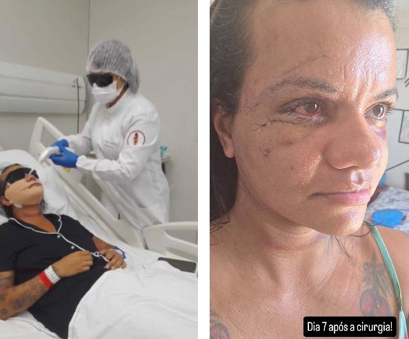 Vítima de 61 socos em elevador mostra rosto após cirurgia de reconstrução facial