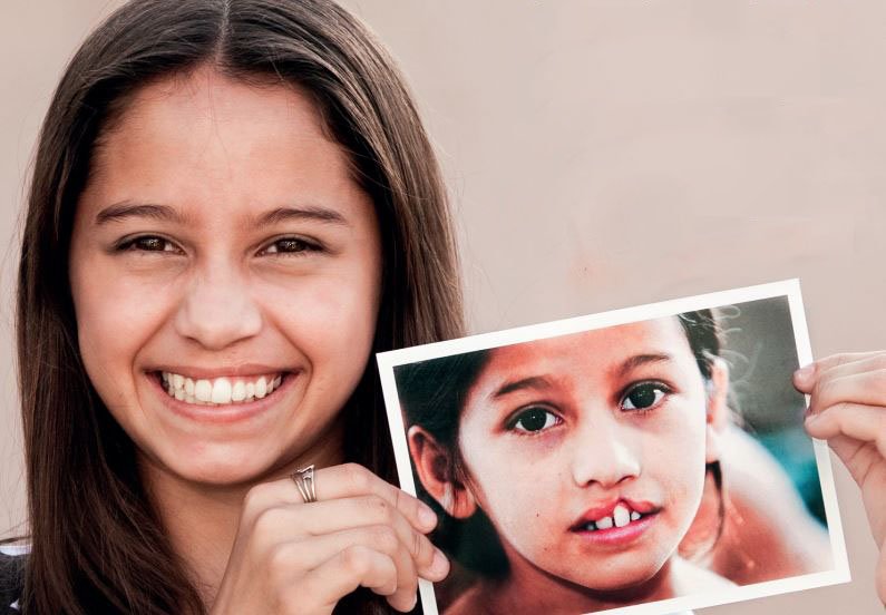Operação Sorriso retorna a Natal com cirurgias gratuitas e capacitação médica; veja como participar