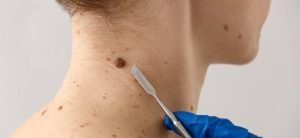 Pesquisadores do RN desenvolvem moléculas promissoras no combate ao melanoma usando inteligência artificial